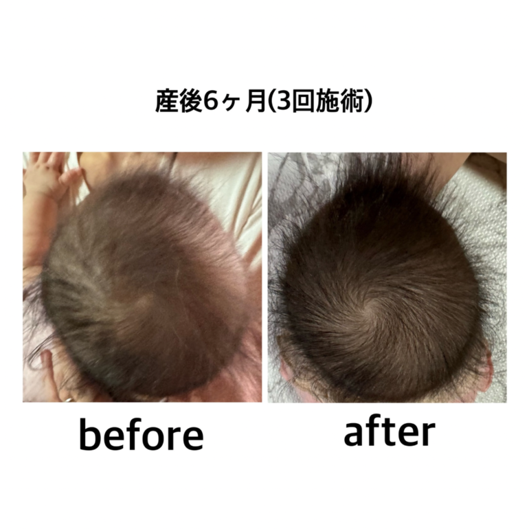 赤ちゃん整体 頭の形 産後6ヶ月 3回施術 before after